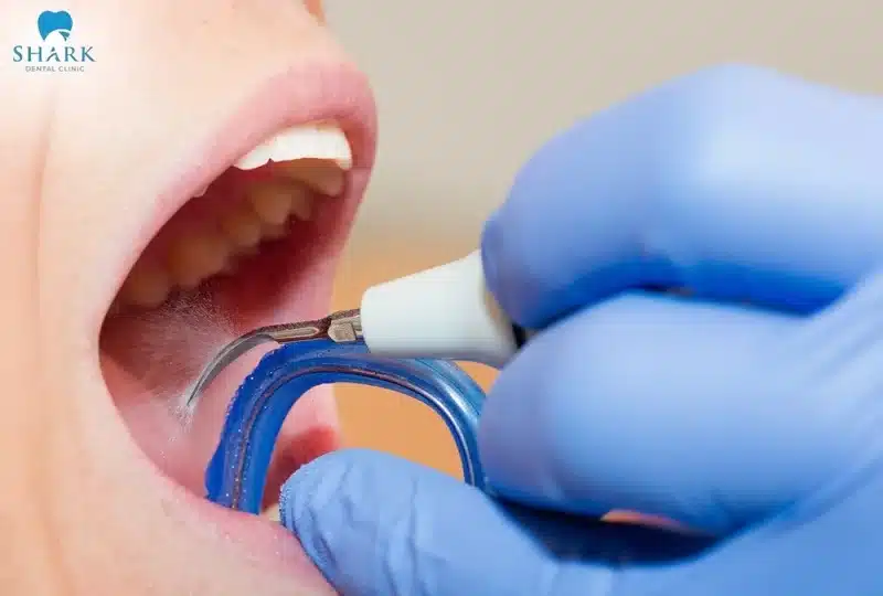 Lấy cao răng tại nha khoa sẽ giúp loại bỏ mảng bám cao răng một cách hiệu quả nhất