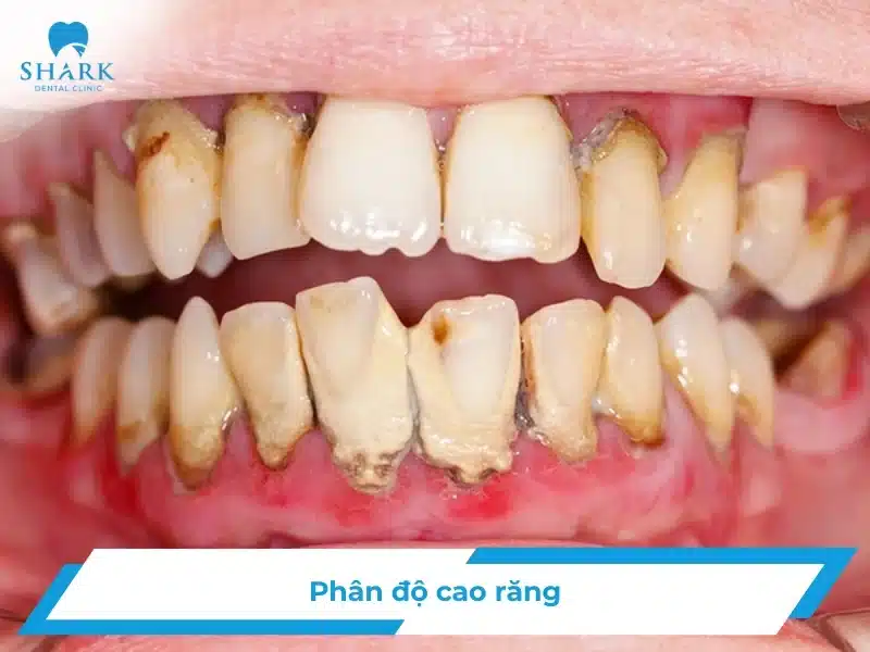 Phân độ cao răng