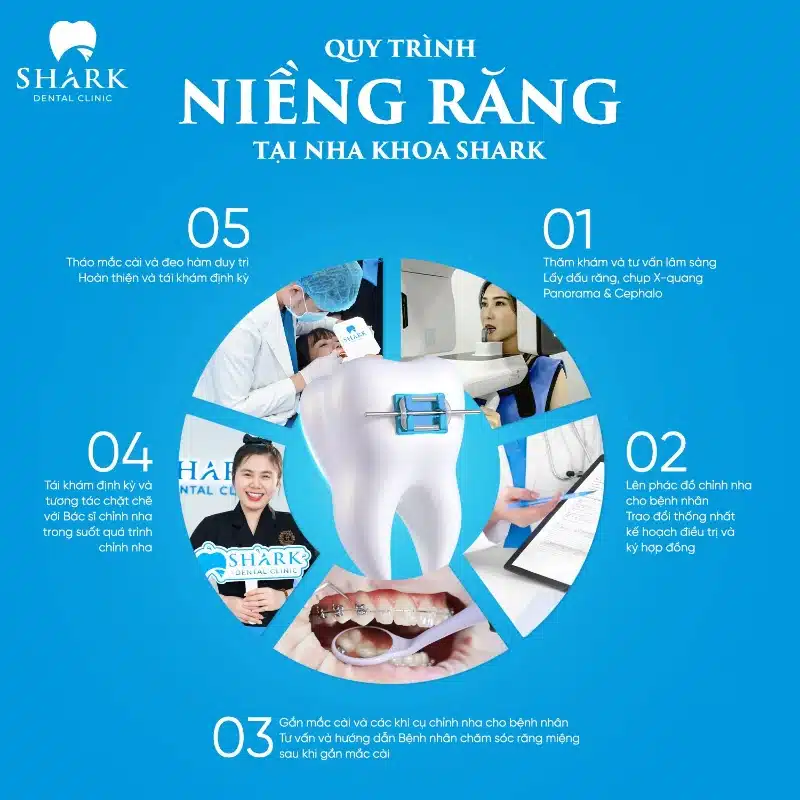 Quy trình niềng răng gồm các giai đoạn nào? Có mấy bước? 10 Quy trình niềng răng chuẩn