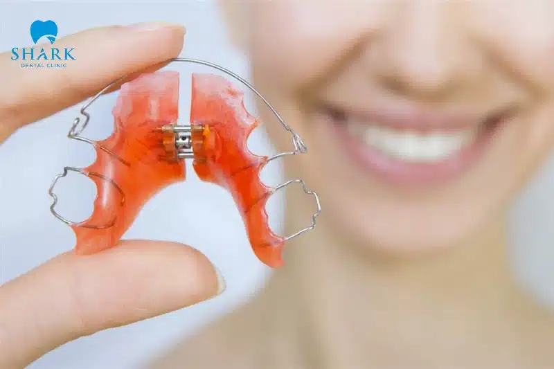 Quy trình niềng răng gồm các giai đoạn nào? Có mấy bước? 12 Đeo hàm duy trì để bảo toàn kết quả sau tháo niềng