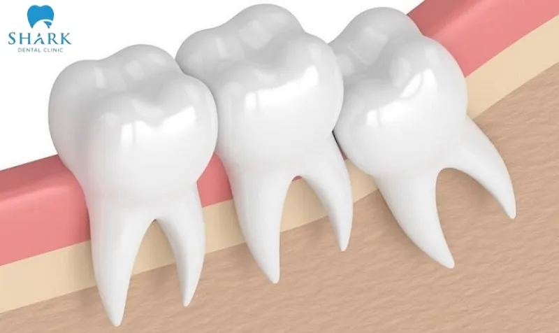 Răng khôn mọc lệch có thể gây ra tình trạng sâu răng