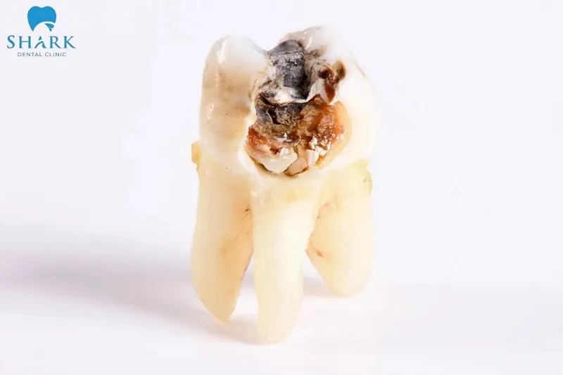 Răng khôn bị sâu có trám được không?  Câu trả lời là có đối với trường hợp mọc thẳng và sâu nhẹ