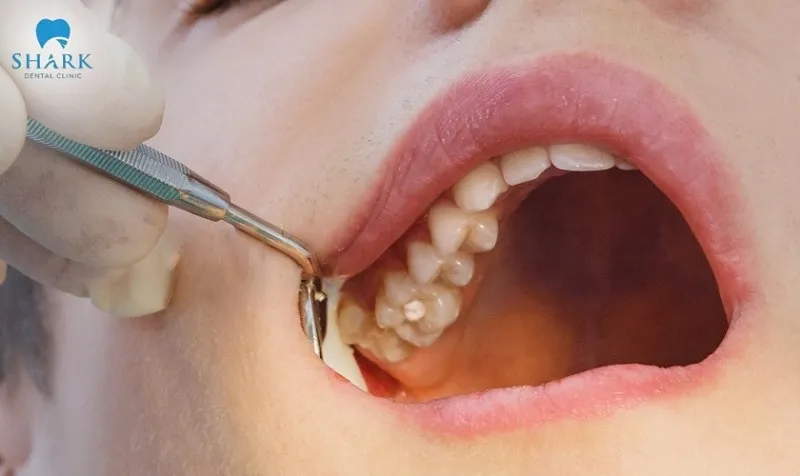 Sau khi trám răng, bác sĩ sẽ kiểm tra lại khớp cắn để không ảnh hưởng đến quá trình ăn nhai của khách hàng. 