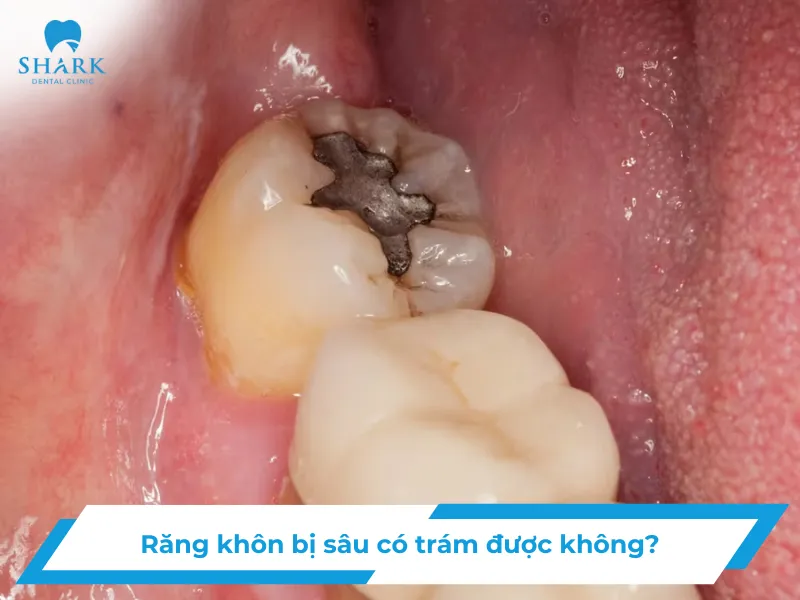 Răng khôn bị sâu có trám được không?