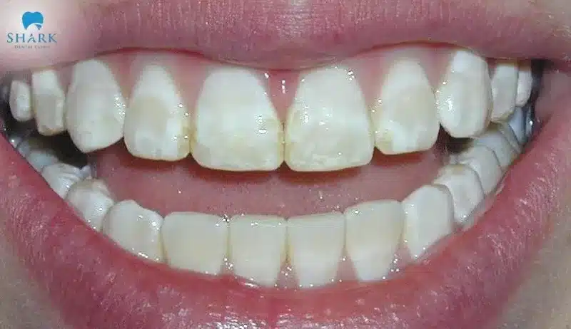 Thiếu sản men răng là gì? Cách để điều trị giảm sản men răng 9 Hình ảnh về giảm sản men răng