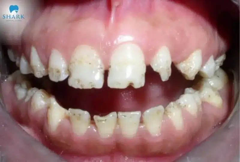 Thiếu sản men răng là gì? Cách để điều trị giảm sản men răng 11 Giảm sản men răng dạng kém khoáng hóa là hiện tượng xuất hiện trong giai đoạn khoáng hóa khung hữu cơ, khiến men răng yếu, dễ bị vỡ, mòn