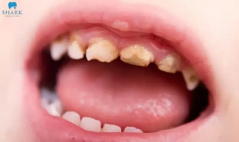 Thiếu sản men răng là gì? Cách để điều trị giảm sản men răng 12 Thiểu sản men răng ở trẻ thường có các dấu hiệu như răng gãy cụt hoặc rụng sớm