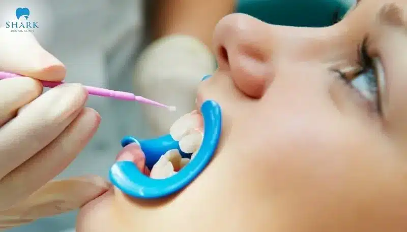 Thiếu sản men răng là gì? Cách để điều trị giảm sản men răng 13 Phủ Sealant được thực hiện trong trường hợp mắc giảm sản men răng giai đoạn nhẹ