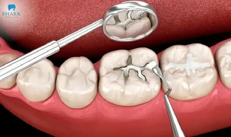 Thiếu sản men răng là gì? Cách để điều trị giảm sản men răng 14 Trám răng là thủ thuật nha khoa giúp phục hình răng sâu, vỡ hoặc mẻ lớn