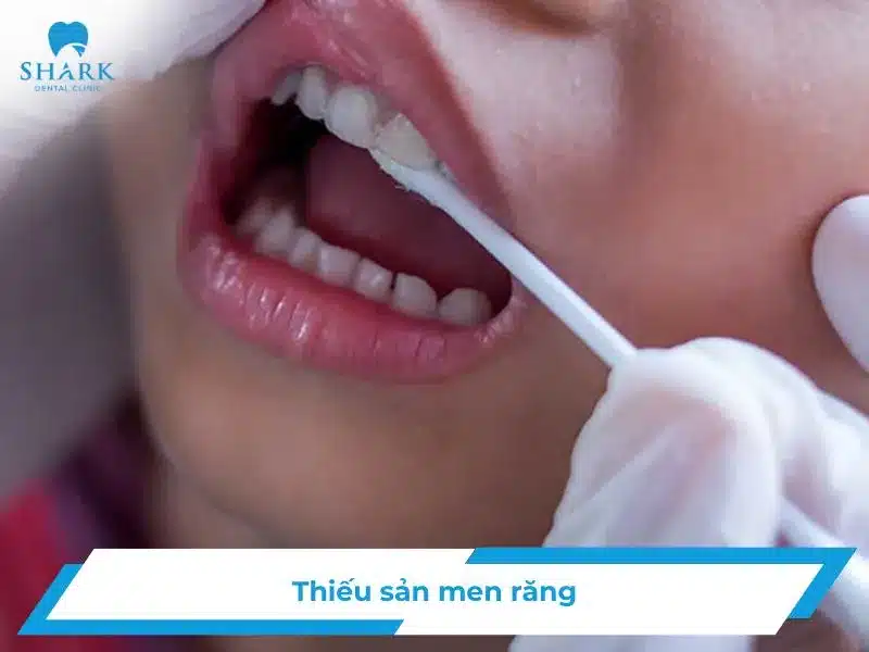 Thiếu sản men răng