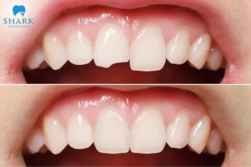 Thời gian trám lại răng sẽ lâu hơn đối với các vị trí như răng cửa
