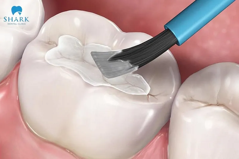 Bạn nên ưu tiên lựa chọn các loại vật liệu trám răng tốt nhất để có được hiệu quả phục hình tối ưu
