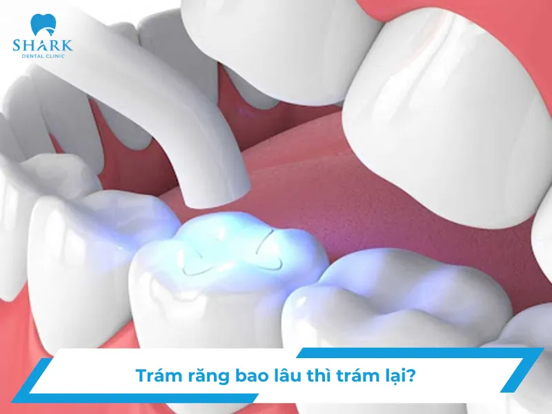 Trám răng bao lâu thì trám lại?