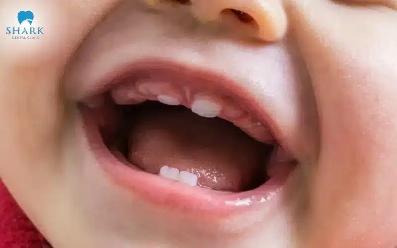 Trẻ mọc cục thịt thừa ở lợi có sao không? Cách để xử lý 9 Nếu lợi của trẻ có cục thịt thừa và chúng không gây đau thì không cần quá lo lắng