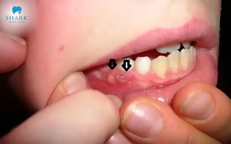 Trẻ mọc cục thịt thừa ở lợi có sao không? Cách để xử lý 10 Khi các cục thịt thừa nổi lên nhiều hơn thì bạn cần đưa trẻ đi khám bác sĩ để thăm khám