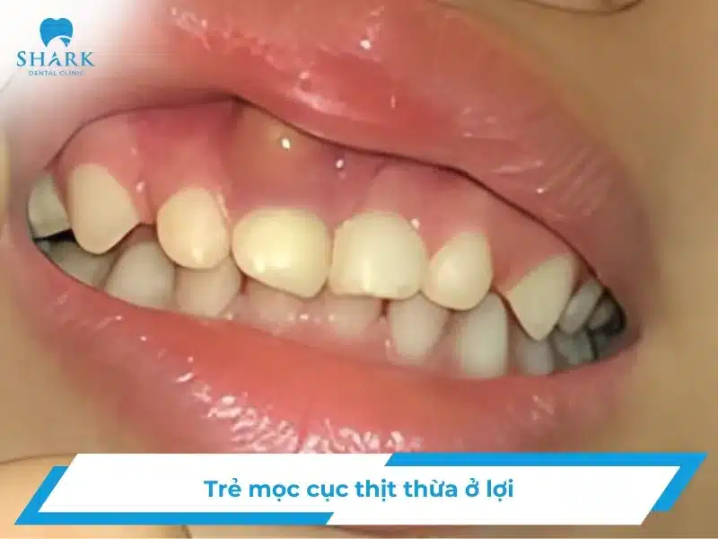Trẻ mọc cục thịt thừa ở lợi