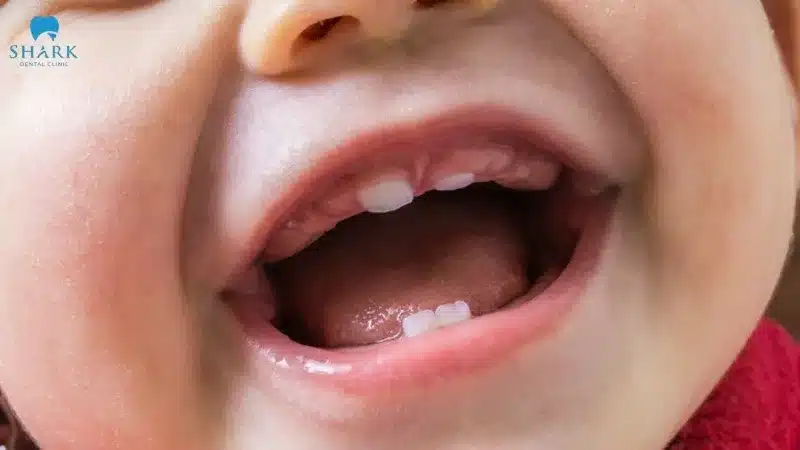 Trẻ mọc răng không đúng thứ tự có sao không? Cần chú ý gì? 6 Trẻ mọc răng sai thứ tự có thể xuất phát từ nguyên nhân di truyền