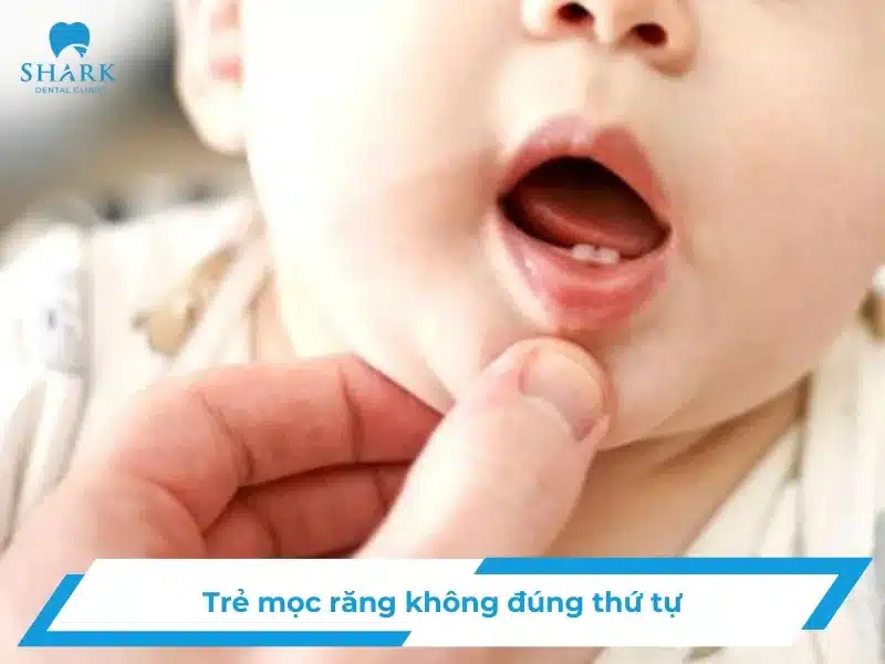 Trẻ mọc răng không đúng thứ tự