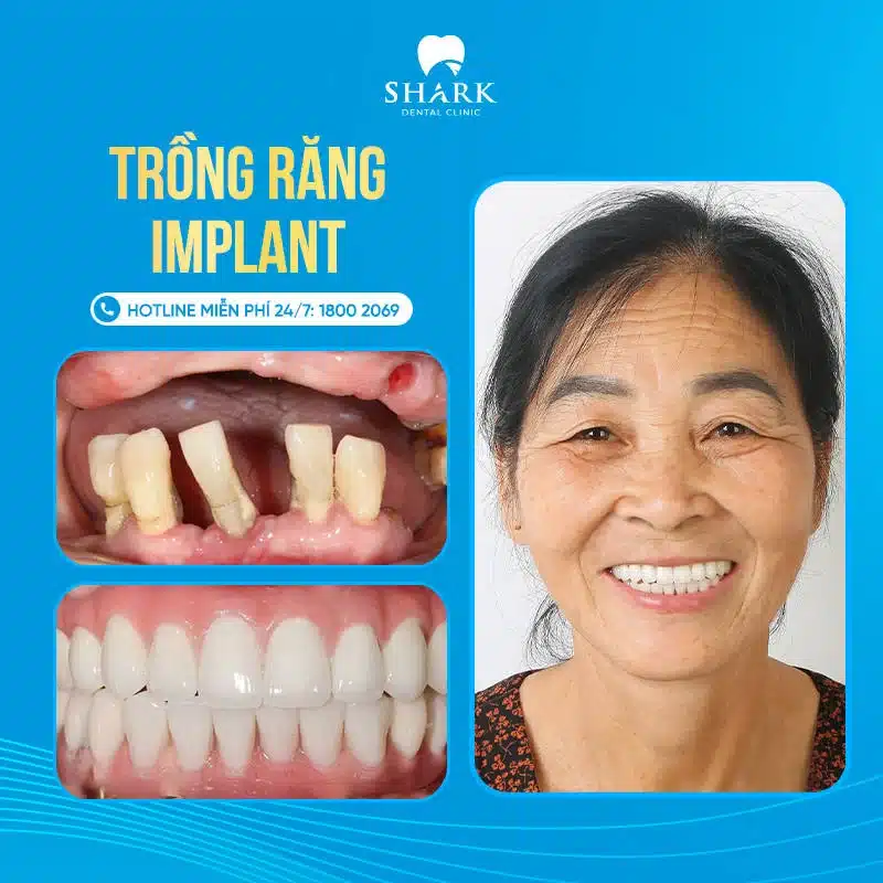 Trồng răng Implant giá bao nhiêu? Bảng giá cấy ghép răng mới 12 Cấy răng implant giá bao nhiêu?