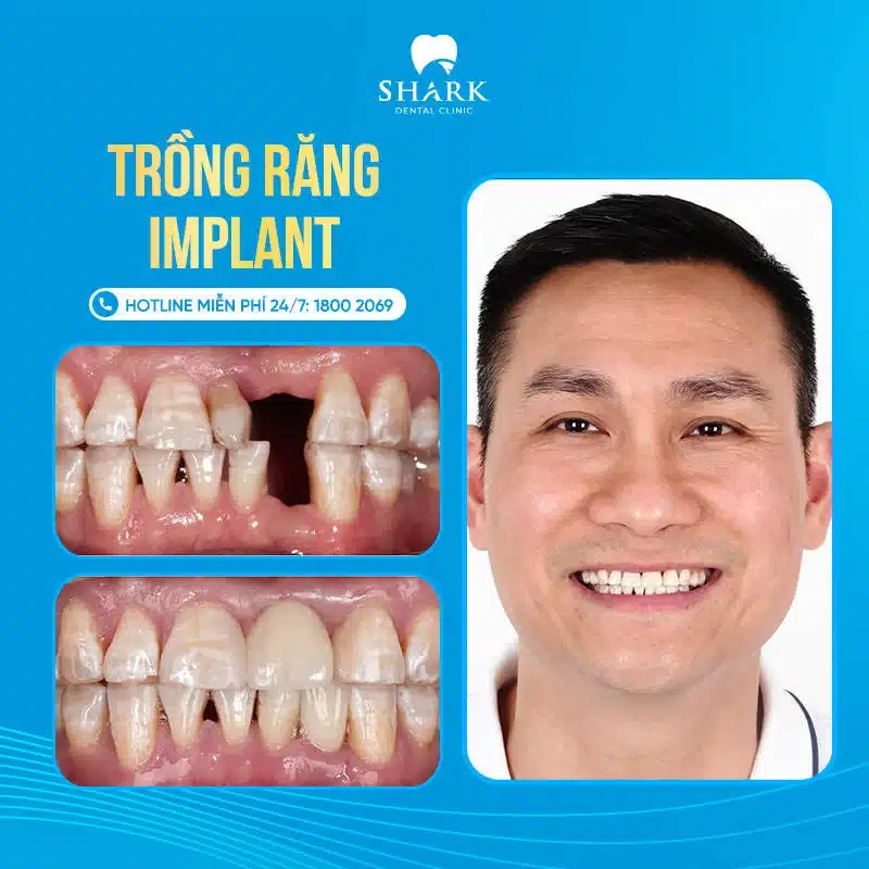 Cấy ghép Implant là gì? Các phương pháp trồng răng hiện nay 17 Khách hàng trồng răng tại nha khoa Shark