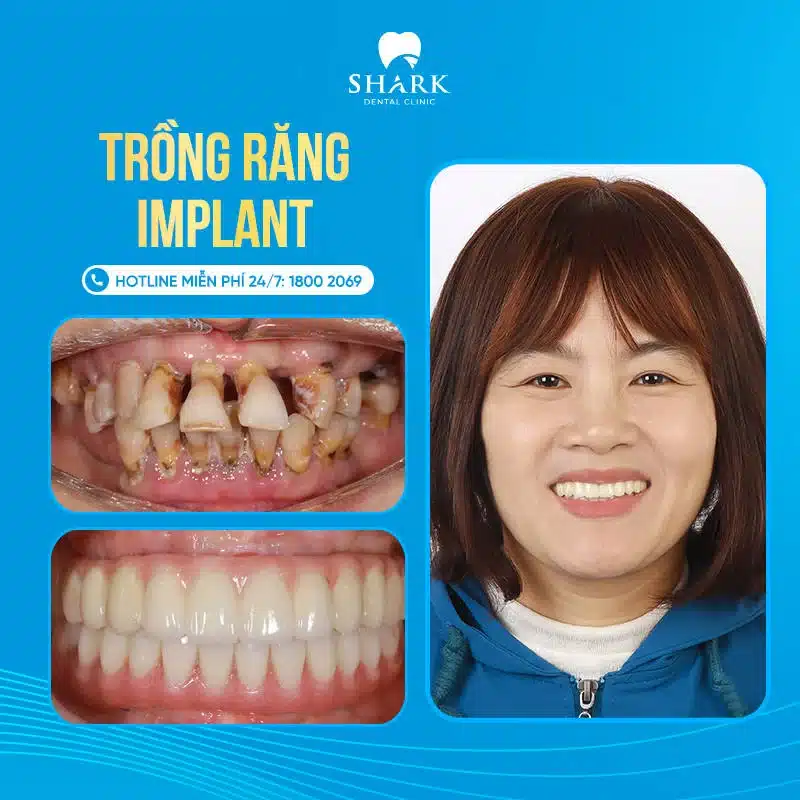 Trồng răng Implant giá bao nhiêu? Bảng giá cấy ghép răng mới 14 Khách hàng trồng răng Implant All on 6 ở Shark Dental