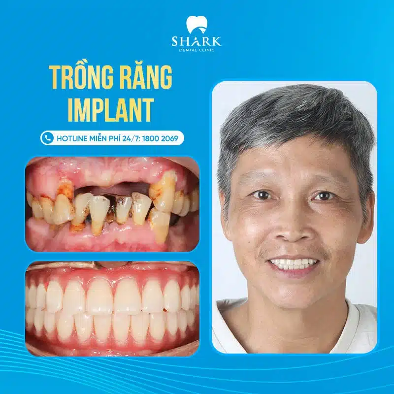 Trồng răng Implant giá bao nhiêu? Bảng giá cấy ghép răng mới 15 Khách hàng trồng răng tại nha khoa Shark