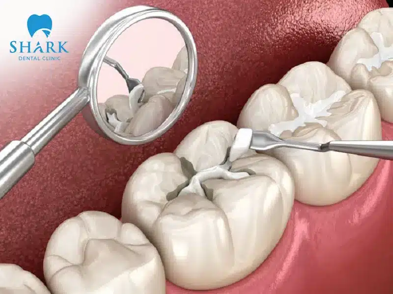 Tự trám răng tại nhà có hiệu quả không? Có nên áp dụng tại nhà? 9 Cần thực hiện trám răng an toàn, đúng quy trình, hạn chế các biến chứng