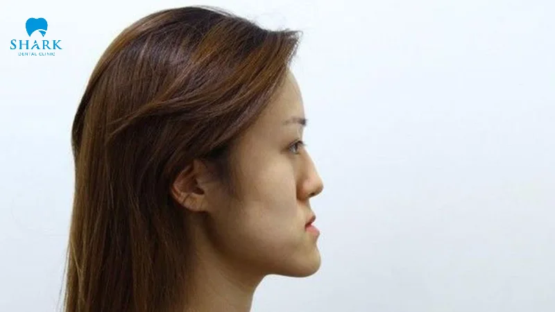 Mặt lưỡi cày nhìn nghiêng