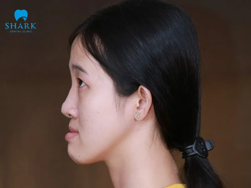 Di truyền là yếu tố hàng đầu dẫn đến tình trạng gương mặt gãy