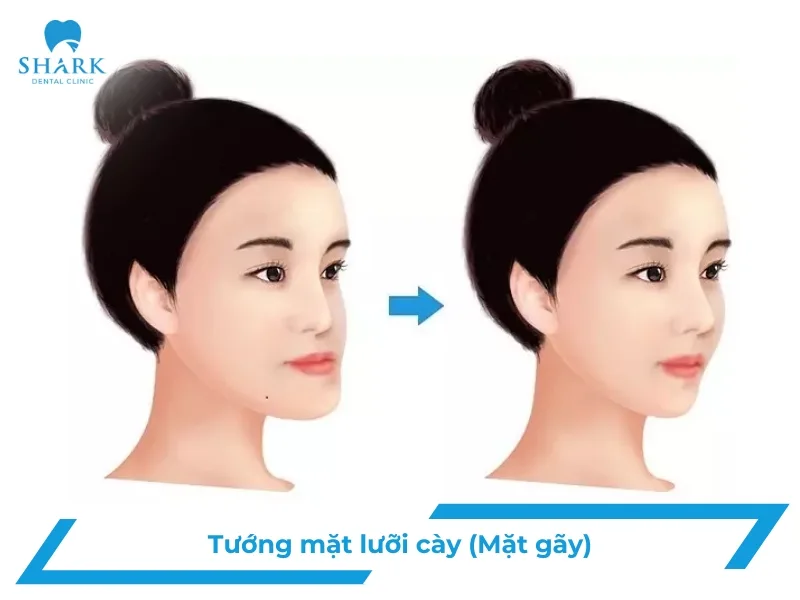 Mặt lưỡi cày