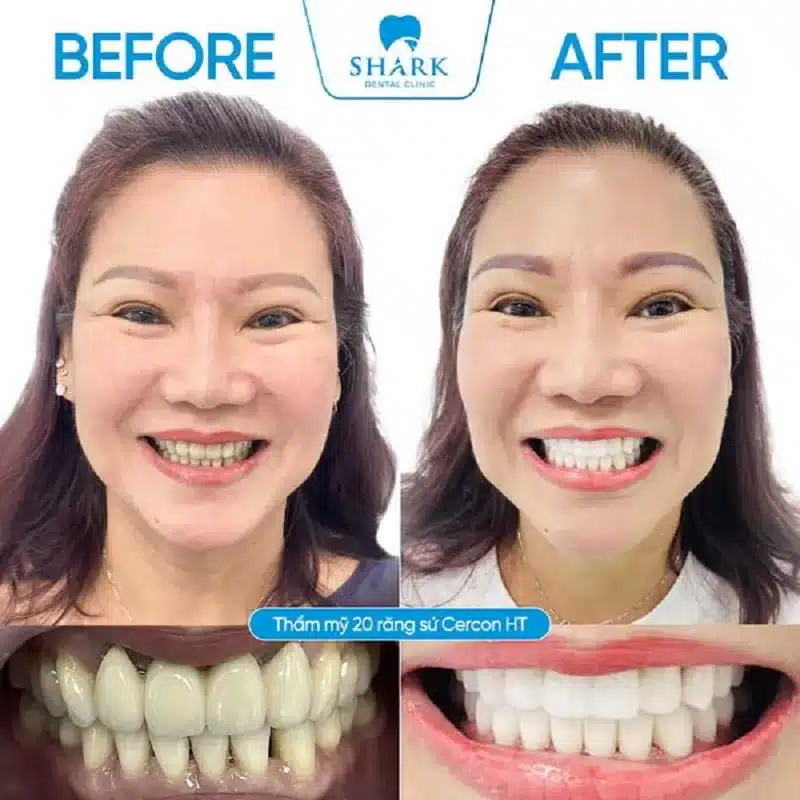 Hình ảnh bọc sứ cercon HT