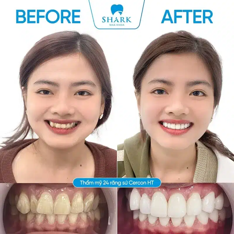 Hình ảnh răng sứ cercon HT
