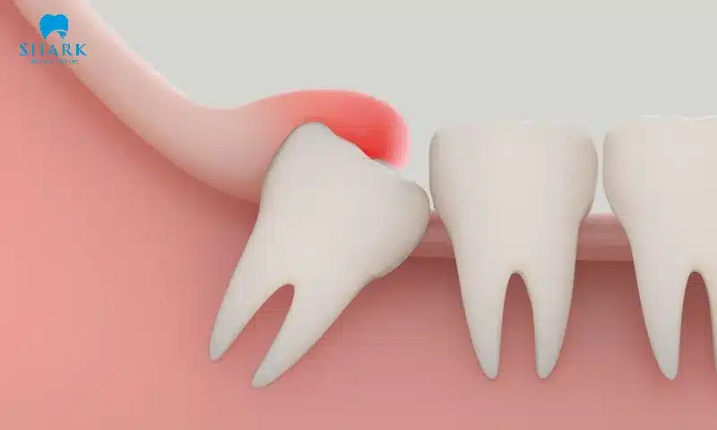 Răng khôn mọc ngang khiến nướu sưng đỏ và gây nên những đau nhức khó chịu