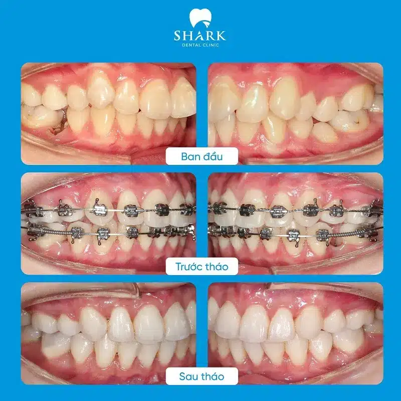 Hình ảnh niềng răng lòi xỉ