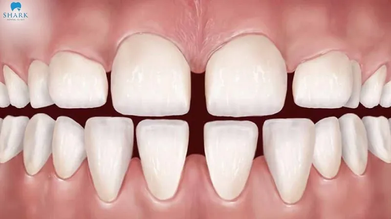 Có nên bọc sứ cho răng thưa không? Giá bao nhiêu? 15 Bọc răng sứ cho răng thưa không phải là giải pháp tối ưu