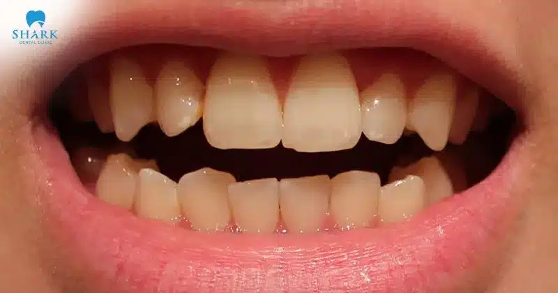 Sử dụng quá nhiều bột than tre dẫn đến răng bị xỉn màu