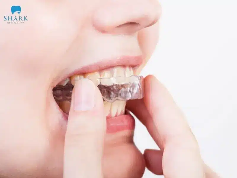Hướng dẫn 15 cách chăm sóc răng miệng an toàn, đúng cách 19 Để giữ an toàn cho răng miệng tối đa, cần mang thêm dụng cụ bảo vệ răng hàm mỗi khi tham gia vận động thể chất