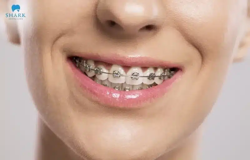 Hướng dẫn 15 cách chăm sóc răng miệng an toàn, đúng cách 20 Khi răng thẳng đều việc vệ sinh răng miệng sẽ trở nên dễ dàng hơn, tránh được tình trạng tích tụ mảng bám, ngăn ngừa sâu răng và viêm nướu