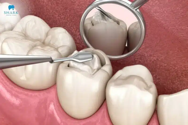 Hướng dẫn 15 cách chăm sóc răng miệng an toàn, đúng cách 21 Trám răng cũng là một cách chăm sóc răng miệng hiệu quả
