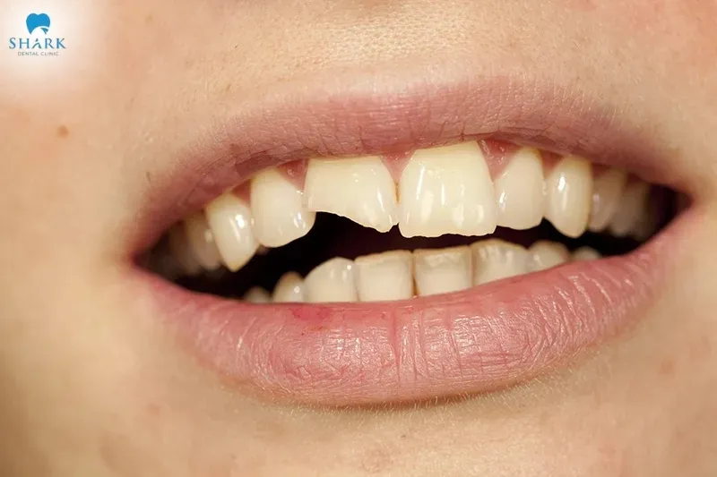 Răng bị mẻ dự báo điềm xấu