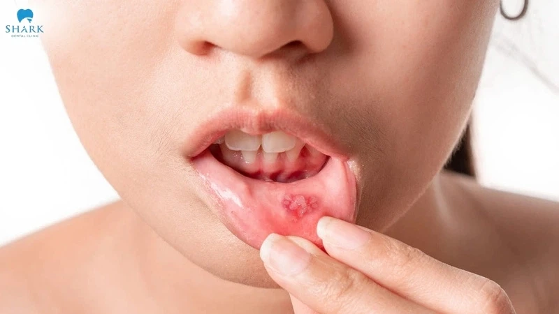 Top 12 cách trị nhiệt miệng trong 1 ngày (qua 1 đêm) hiệu quả 9 Nhiệt miệng là một dạng tổn thương niêm mạc miệng, gây đau rát, khó chịu, cản trở quá trình ăn uống và giao tiếp hàng ngày