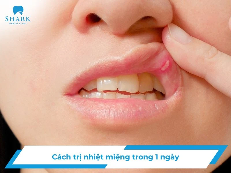 Cách trị nhiệt miệng trong 1 ngày