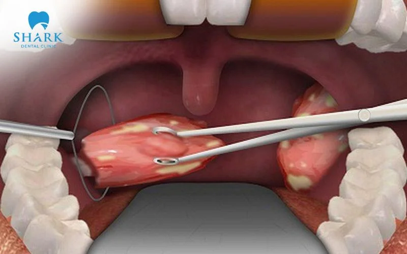 Không phải ai cắt amidan cũng hết hôi miệng, hiệu quả còn phụ thuộc vào nguyên nhân chính
