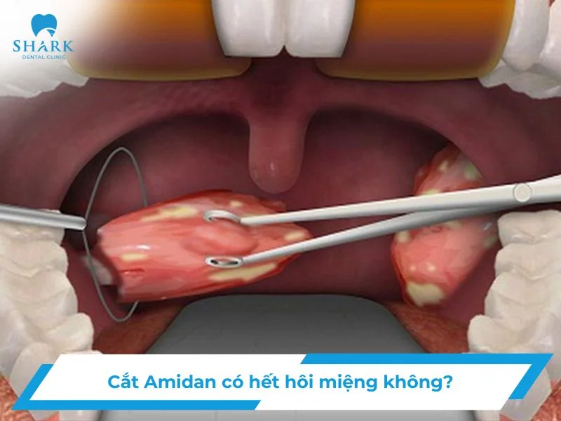Cắt amidan có hết hôi miệng không
