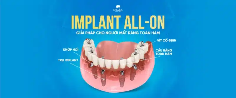 Trồng răng toàn hàm All on 4