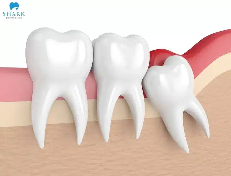 Trường hợp nên nhổ răng khôn