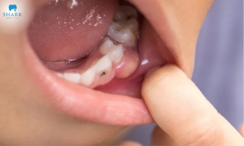 11 dấu hiệu nhiễm trùng sau khi nhổ răng khôn bạn nên biết 11 Nhổ răng khôn bị nhiễm trùng
