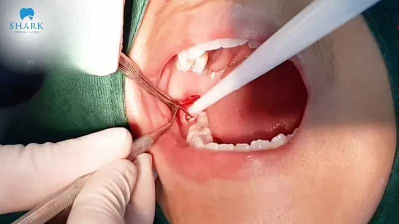 11 dấu hiệu nhiễm trùng sau khi nhổ răng khôn bạn nên biết 15 Dụng cụ nhổ răng khôn không được sát khuẩn khiến cho việc nhiễm trùng rất dễ xảy ra