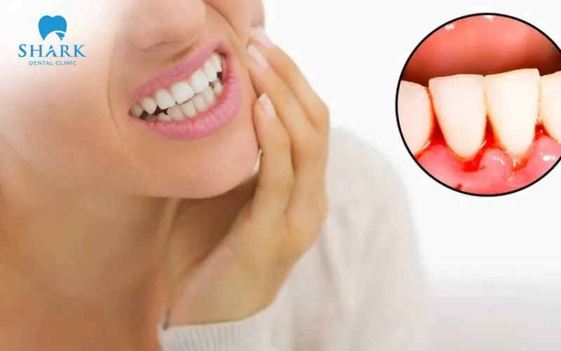 Nhổ răng khôn vào kỳ kinh nguyệt dễ gây chảy máu nhiều hơn và khó cầm máu