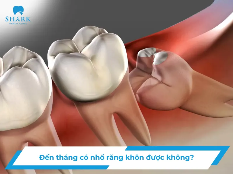 Đến tháng có nhổ răng khôn được không?